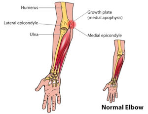 Little League Elbow- pain felt on inner side of elbow