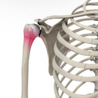 Little League Shoulder
