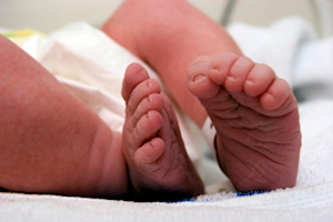 Congenital foot posture (positional talipes) image