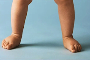 Flat Feet (Pes Planus) image Flat Feet (Pes Planus) image