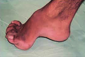 High Arch Foot (Pes Cavus) image High Arch Foot (Pes Cavus) image