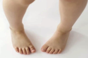 In-toeing image In-toeing image