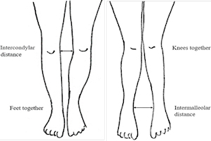 Knock-knees (Genu Valgum) graphic Knock-knees (Genu Valgum) graphic