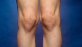 Knock Knees (genu valgum) Knock Knees (genu valgum)