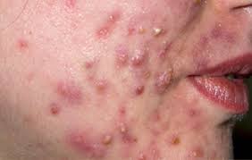 Acne Acne