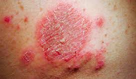Eczema