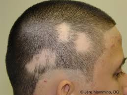 Alopecia Alopecia