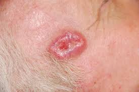 Basal Cell Carcinoma (Rodent Ulcers)