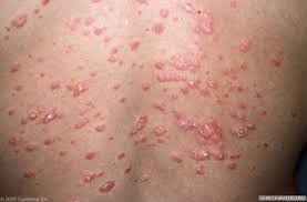 Psoriasis