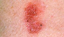 Squamous cell carcinoma/Bowen’s Disease Squamous cell carcinoma/Bowen’s Disease