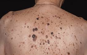 Seborrhoeic Keratosis Seborrhoeic Keratosis