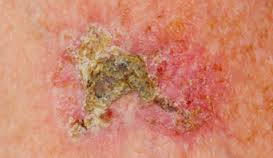 Actinic Keratosis Actinic Keratosis