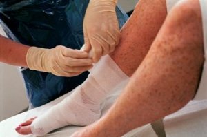 Lymphoedema Service Lymphoedema Service