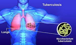TB Service North Central London TB Service North Central London