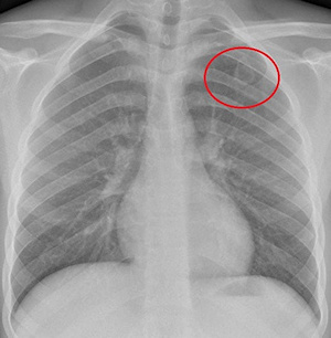 Asymptomatic 15 year old boy Asymptomatic 15 year old boy