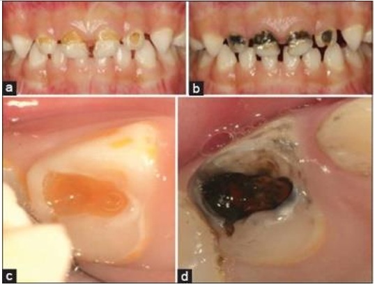 Silver Diamine Fluoride treatment image
