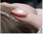 Cotton wool in ear image