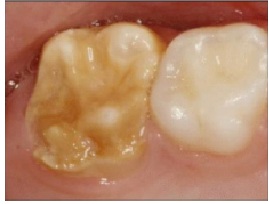 MIH picture of teeth