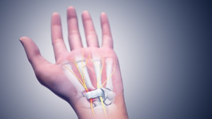 Carpal Tunnel Syndrome Carpal Tunnel Syndrome