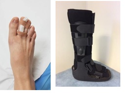 Stapping toes and boot