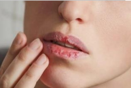 Dry lips image