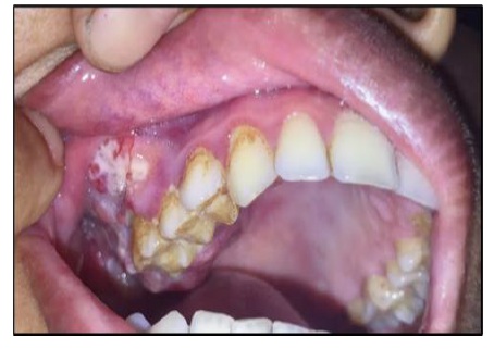 Mouth cancer image