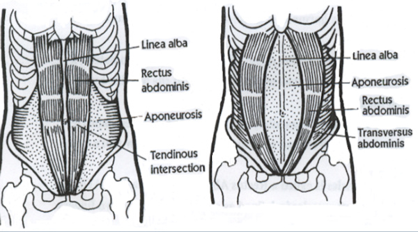 Diastasis rectus abdominus muscle graphic Diastasis rectus abdominus muscle graphic