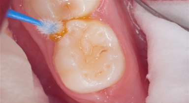 Fluoride varnish image