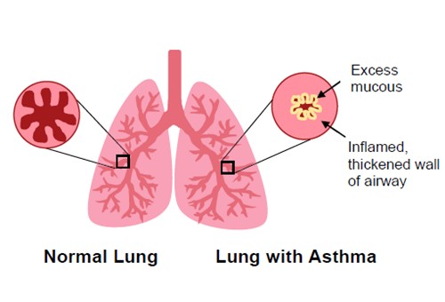Diagram of lungs with and without asthma