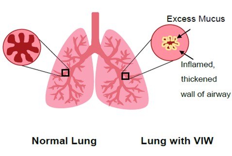 Diagram of lungs with and without excess mucus