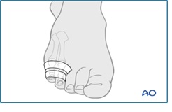 Toe strapping image