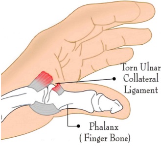 Torn ulner image
